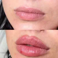 مدل جهت تزریق فیلر لب توسط پزشک و تولید محتوا