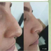 بیا تا بهت بگم چجوری بدون عمل بینی تو کوچیک کنی