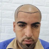 کاشت مو طبیعی به روش سوپر میکروگرفت