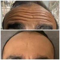 جشنواره بوتاکس و مزوژل و مزوتراپی در مطب پزشک