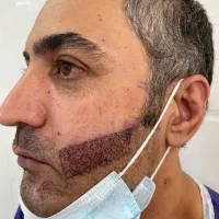 کاشت مو و ابرو و ریش|خدمات آرایشگری و زیبایی|شیراز, قدوسی غربی|دیوار