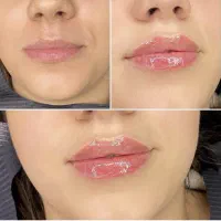 جشنواره ژل لب چانه زاویه جوانسازی بوتاکس لیفت|خدمات آرایشگری و زیبایی|تهران, گیشا|دیوار