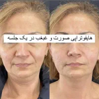 جشنواره لاغری 3تا12سانت در1جلسه وهایفوتراپی vip|خدمات آرایشگری و زیبایی|رشت, پارک شهر|دیوار