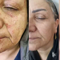 صافی مو کراتین وپروتین وخال برداری