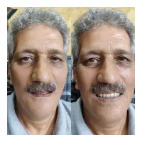 دندان ،دندان سازی ،دندان مصنوعی ،جوان پسند،اقساطی|خدمات آرایشگری و زیبایی|مشهد, شاهد (شهرک غرب)|دیوار