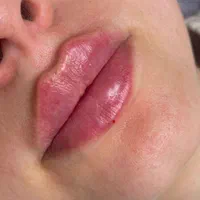 ژل بوتاکس فیلر چشم زاویه فک گونه چانه فشیال بیکینی|خدمات آرایشگری و زیبایی|قم, زنبیل آباد|دیوار