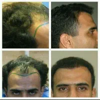 کلینیک  تخصصی کاشت مو و ابرو