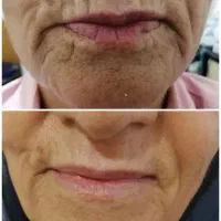 لیفت صورت و جوانسازی در یک جلسه|خدمات آرایشگری و زیبایی|شیراز, زند|دیوار