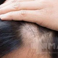 درمان ریزش شدید مو|آرایشی، بهداشتی، درمانی|شیراز, نیستان|دیوار