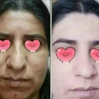 کرم درمان لکه و کک و مک و....|آرایشی، بهداشتی، درمانی|میاندوآب, |دیوار