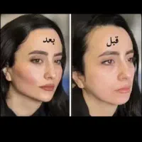 جشنواره ی پاییزه ی فیلر وبوتاکس