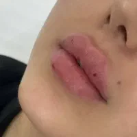 تزریق تخصصی ژل و بوتاکس زیر نظر متخصصین مجرب|خدمات آرایشگری و زیبایی|کرمانشاه, |دیوار