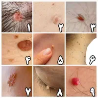 بهبود زگیل و تبخ*ال