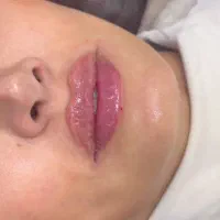 اف ویژه تزریق فیلر و بوتاکس و..در کلینیک توسط پزشک|خدمات زیبایی و سلامت|کرج, گوهردشت|دیوار