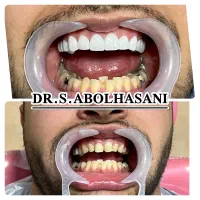 لمینت لیرینگ  ده تومن پیش پرداخت اصفهان|خدمات آرایشگری و زیبایی|شهرضا, |دیوار