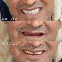 دندان مصنوعی متحرک اقساط ویژه بازنشستگان