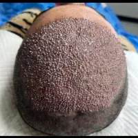 کاشت مو|خدمات آرایشگری و زیبایی|اهواز, نادری|دیوار