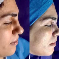 جراحی بینی ۲۳ بدون بیهوشی