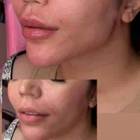 تزریقات ژل و بوتاکس و آنزیم|خدمات آرایشگری و زیبایی|اسلام‌شهر, شهرک مهدیه|دیوار