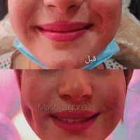 تزریق ژل بوتاکس چال گونه تتو پرسینگ مژه و اموزش|خدمات آرایشگری و زیبایی|اهواز, معین زاده|دیوار