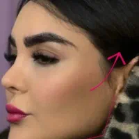 تزریق ژل وبوتاکس/هیرفیلر/لیزرکلینیک با تخفیف