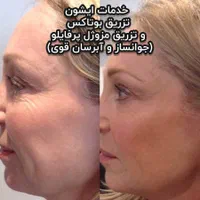 بوتاکس،ژل لب روسی،لیزر|خدمات آرایشگری و زیبایی|اسلام‌شهر, شهرک واوان|دیوار