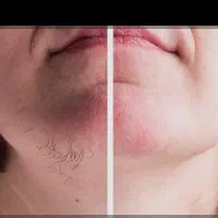 الکترولیز|خدمات آرایشگری و زیبایی|شیراز, میانرود|دیوار