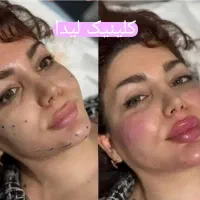 جشنواره ژل لب فیلرمزو1050بوتاکس950 پزشک متخصص
