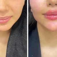 اف ویژه لیپوماتیک ترانسفر باسن تزریق چربی ۱ هفته