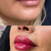 نیازمندمدل تزریق فیلر چانه،لب،زاویه، گونه کات|خدمات آرایشگری و زیبایی|تهران, صد دستگاه|دیوار