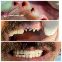 تخفیف ویژه ایمپلنت دیجیتال، کامپوزیت و لمینت