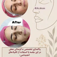 فیشیال و پاکسازی پوست