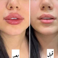 تزریقات و‌بوتاکس کاملا قسطی
