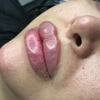 ژل لب فیلر بوتاکس پی ار پی فیلر گونه خط خنده