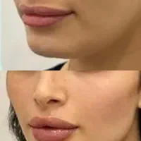 تخفیف ۵۰٪ بوتاکس|خدمات آرایشگری و زیبایی|تهران, کیانشهر|دیوار