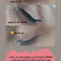 پاک کردن یا ریموو تک جلسه ای صورت و بدن