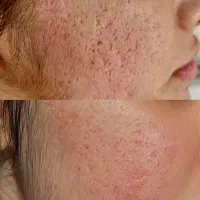 تخفیفات ویژه بوتاکس پی ار پی مزو فیلر چربی در مطب