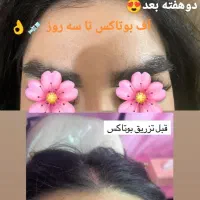 ژل،بوتاکس،مزوتراپی،مزونیدلینگ|خدمات آرایشگری و زیبایی|دوگنبدان, |دیوار