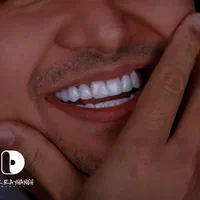کامپوزیت/لمینت/دندانپزشکی|خدمات آرایشگری و زیبایی|مشهد, کوثر|دیوار