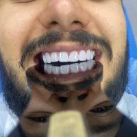 کامپوزیت دندان|خدمات آرایشگری و زیبایی|اندیشه, شهرک صدف|دیوار
