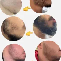 رویش ریش و سبیل و مو تظمینی