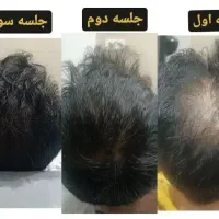 درمان ریزش مو،پوسته،شوره،خارش و بیماری های قارچی|خدمات آرایشگری و زیبایی|شیراز, شهرک امیر کبیر|دیوار