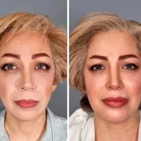 ژل وبوتاکس تزریق حرفه ای 50%تخفیف (خانمها واقایان)