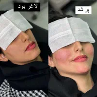 ژل و فیلر صورت و بدن|خدمات آرایشگری و زیبایی|اصفهان, ملک|دیوار