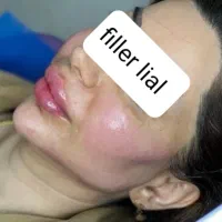آف محدود ژل و بوتاکس فقط سی سی۴۵۰تا آخر هفته|خدمات آرایشگری و زیبایی|اهواز, پردیس|دیوار
