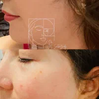 بوتاکس و فیلر صورت برای مدل تحت نظر پزشک|خدمات آرایشگری و زیبایی|زنجان, |دیوار