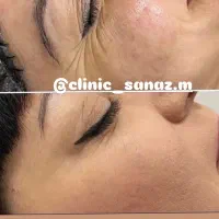 تخفیف ویژه ژل وبوتاکس|خدمات آرایشگری و زیبایی|ایذه, |دیوار