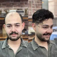 پروتز مو و خدمات پروتز مو اصفهان