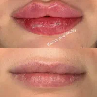 آموزش و انجام تمامی خدمات تزریق ژل،بوتاکس،آنزیم،نخ