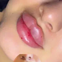 جشنواره فیلر و بوتاکس با بهترین متریال|خدمات آرایشگری و زیبایی|یزد, |دیوار